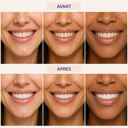 bandes-blanchissantes-dentaires-20260516175315-02_grille_avant_apres.png